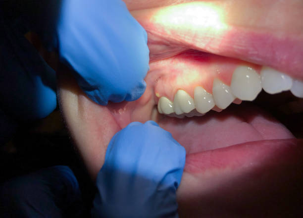Best Broken or Cracked Tooth Emergency Dentist in New Hempstead, NY